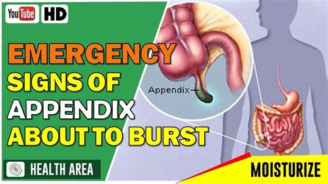 Can your appendix burst without pain?